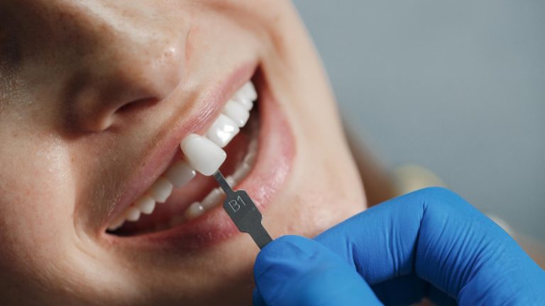 Implant dentaire : retrouver la force et la santé de vos dents